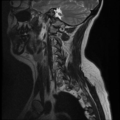 File:Normal cervical and thoracic spine MRI (Radiopaedia 35630-37156 Sagittal T2 1).png