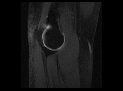 File:Normal elbow arthrograms (Radiopaedia 75550-86805 Sagittal T1 fat sat 13).jpg