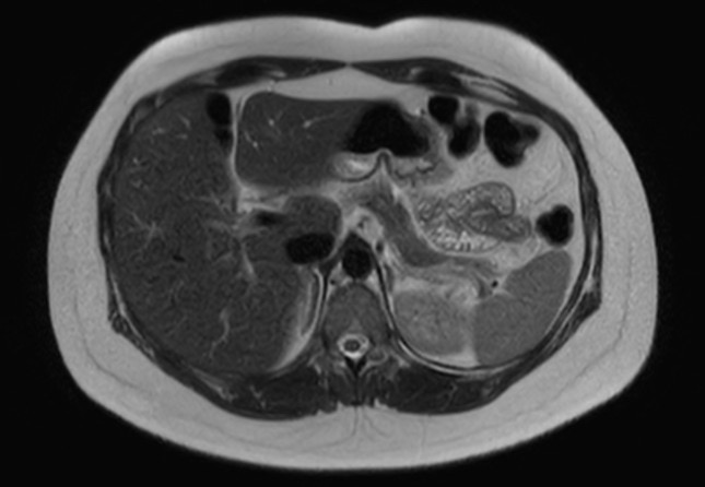 File:Normal liver MRI with Gadolinium (Radiopaedia 58913-66163 Axial T2 21).jpg