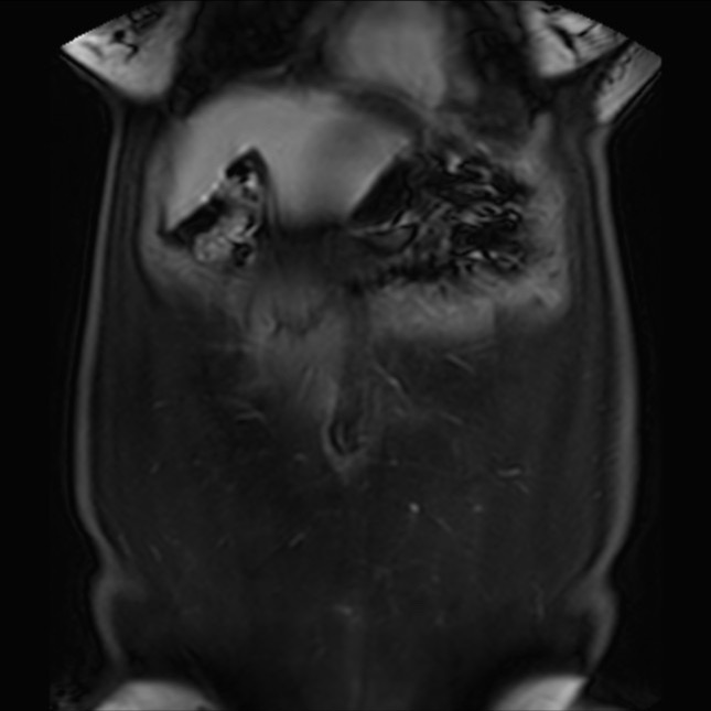 Normal liver MRI with Gadolinium (Radiopaedia 58913-66163 P 17).jpg