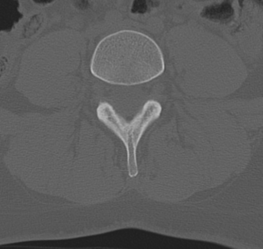 File:Normal lumbar spine CT (Radiopaedia 46533-50986 Axial bone window 50).png