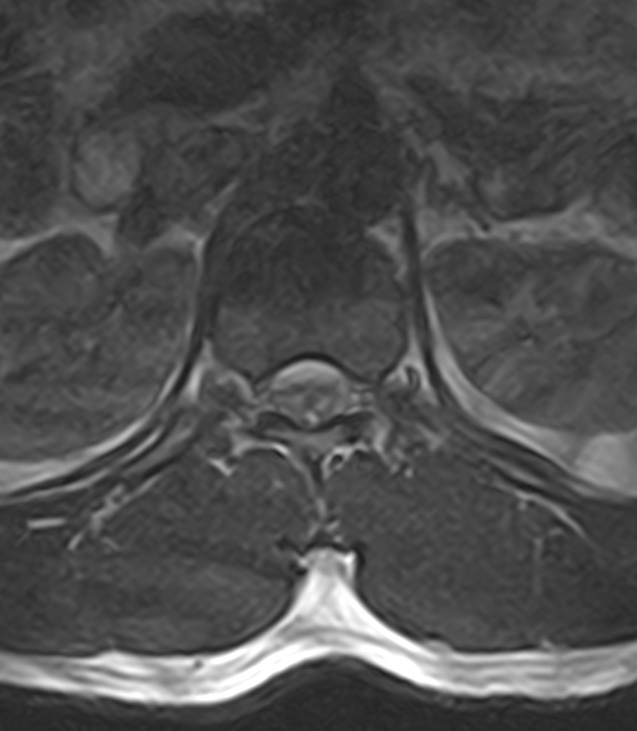 Normal lumbar spine MRI - low-field MRI scanner (Radiopaedia 40976-43699 Axial T2 15).jpg