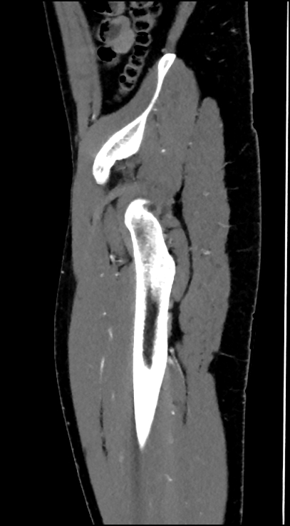 Normal pelvis CT angiogram (Radiopaedia 84966-100481 C 91).jpg