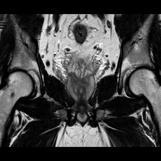 File:Normal prostate (MRI) (Radiopaedia 29986-30535 Coronal T2 11).jpg