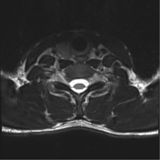 Normal trauma cervical spine (Radiopaedia 41017-43762 D 45).png