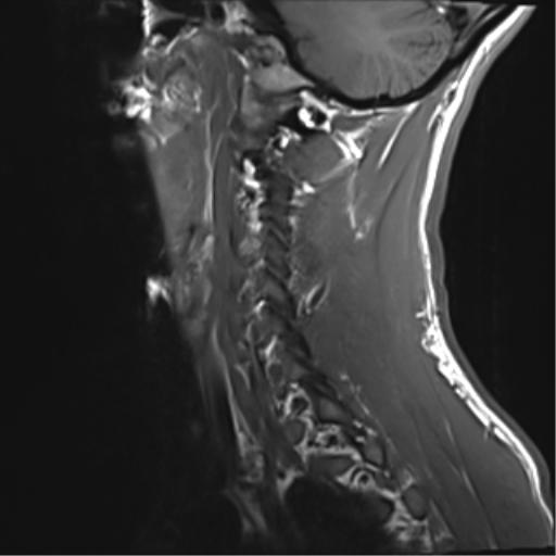 File:Normal trauma cervical spine (Radiopaedia 41017-43762 Sagittal T1 2).png