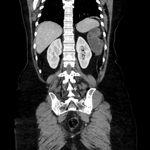 Obstructive distal colonic adenocarcinoma causing cecal perforation (Radiopaedia 86830-102989 C 131).jpg