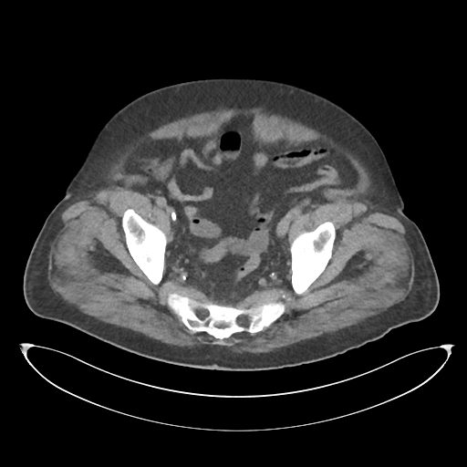 File:Obstructive pyelonephritis (Radiopaedia 46411-50844 Axial non-contrast 67).png