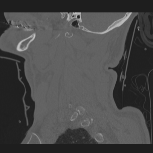 File:Occipital condyle fracture (Radiopaedia 33467-34517 Sagittal bone window 12).png