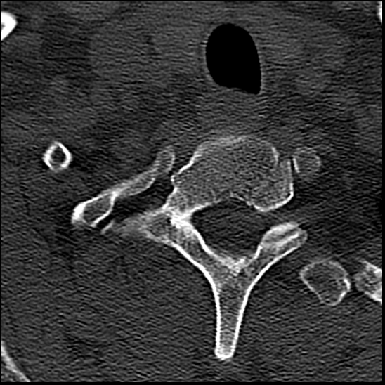 Occipital condyle fracture (type 1) (Radiopaedia 87670-104084 Axial bone window 86).jpg
