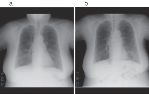 a,b)Hollow lesion in the lower left lung field was diagnosed as a lung abscess