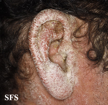 File:Psoriasis (Dermatology Atlas 55).jpg