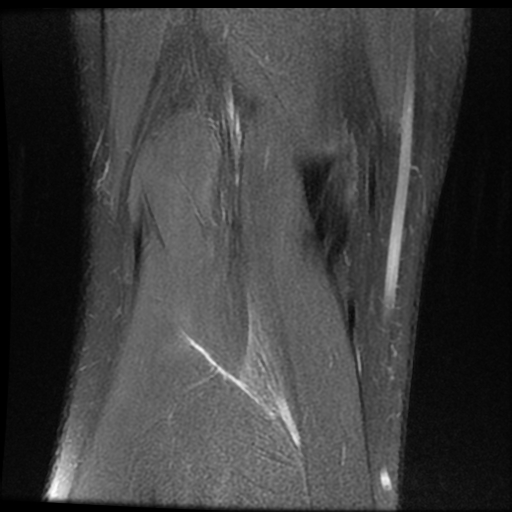 File:ACL acute full thickness tear - deep lateral femoral sulcus sign (Radiopaedia 38594-40740 Coronal PD fat sat 19).jpg