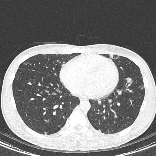 AIDS-related Kaposi sarcoma (Radiopaedia 85247-100811 Axial lung window 115).jpg