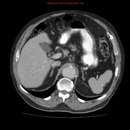 Abdominal aortic aneurysm (Radiopaedia 10122-10660 Axial C+ portal venous phase 19).jpg