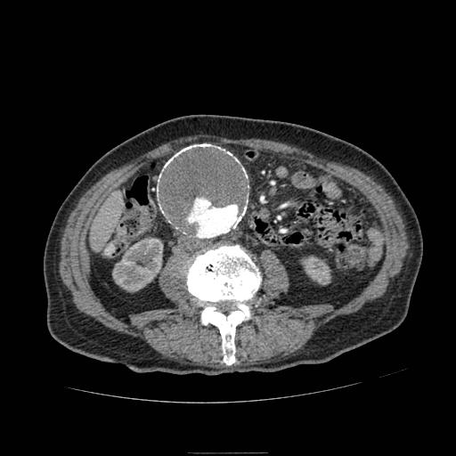 Abdominal aortic aneurysm (Radiopaedia 13341-13340 Axial C+ arterial phase 109).jpg