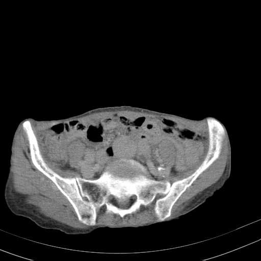 File:Abdominal aortic aneurysm (Radiopaedia 20827-20742 Axial C+ delayed 25).jpg