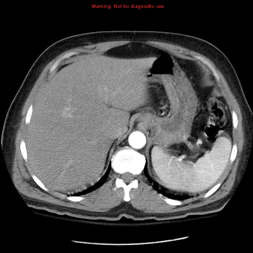 Abdominal aortic aneurysm (Radiopaedia 8190-9038 Axial C+ arterial phase 17).jpg