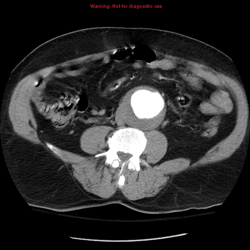 Abdominal aortic aneurysm (Radiopaedia 8190-9038 Axial C+ arterial phase 48).jpg