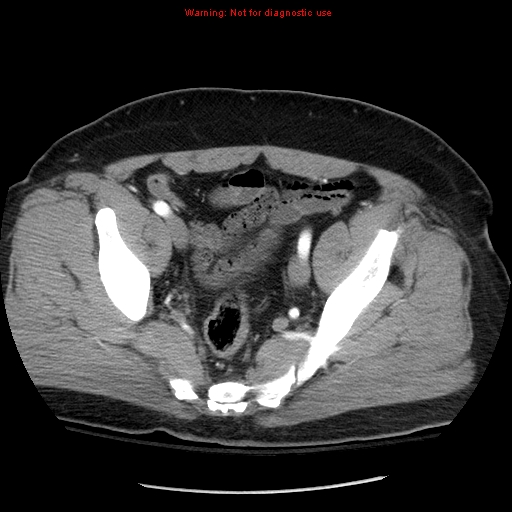 Abdominal aortic aneurysm (Radiopaedia 8190-9038 Axial C+ arterial phase 71).jpg
