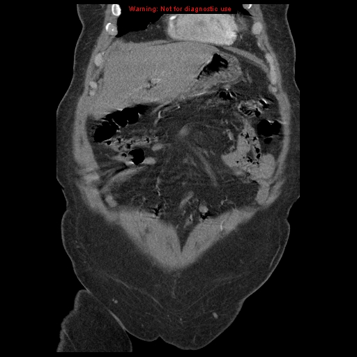Abdominal aortic aneurysm (Radiopaedia 8190-9038 Coronal C+ arterial phase 26).jpg