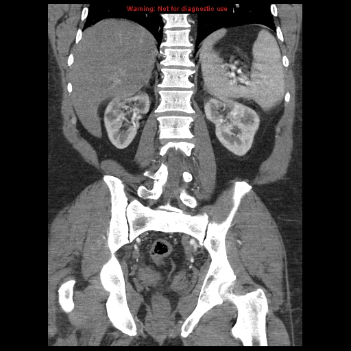 Abdominal aortic aneurysm (Radiopaedia 8190-9038 Coronal C+ arterial phase 89).jpg