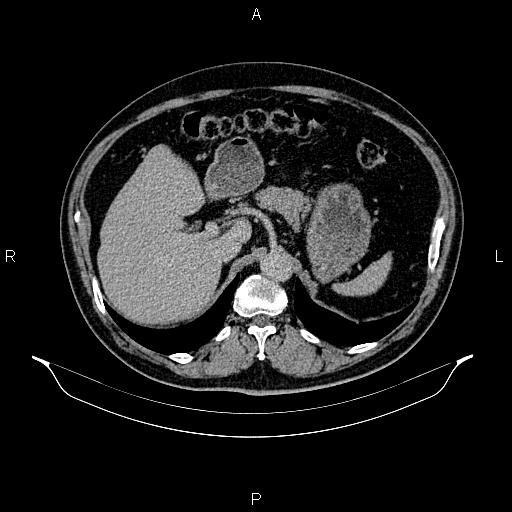 Abdominal aortic aneurysm (Radiopaedia 83094-97462 Axial renal excretory phase 32).jpg