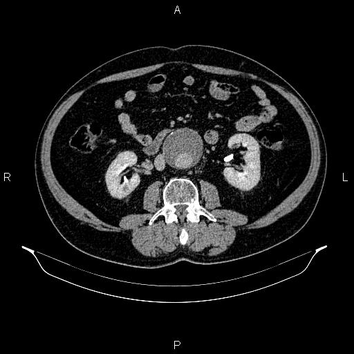 Abdominal aortic aneurysm (Radiopaedia 83094-97462 Axial renal excretory phase 53).jpg