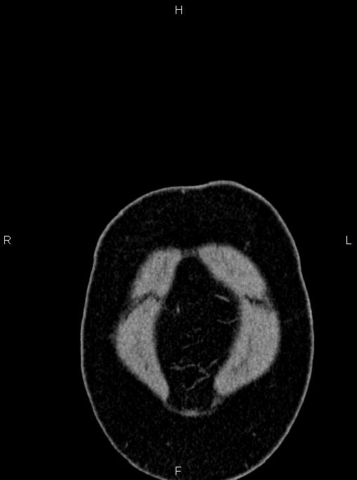 Abdominal aortic aneurysm (Radiopaedia 83094-97462 Coronal renal cortical phase 3).jpg
