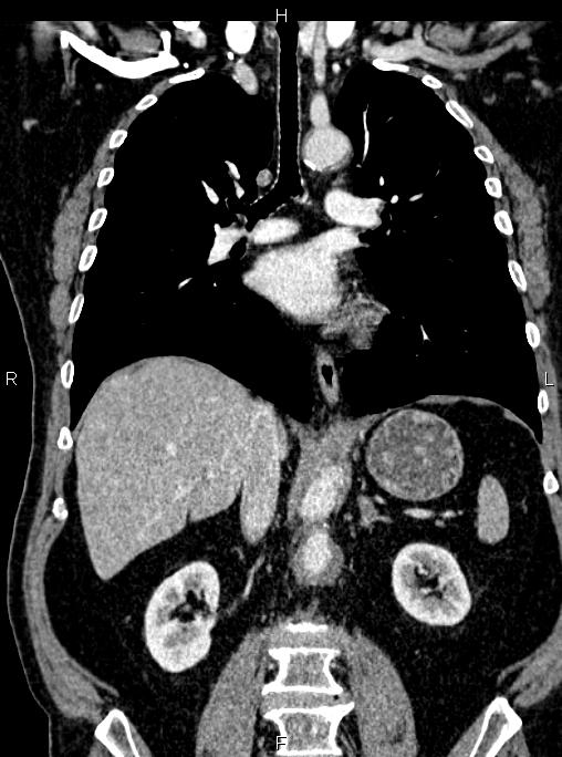 Abdominal aortic aneurysm (Radiopaedia 83094-97462 Coronal renal cortical phase 53).jpg