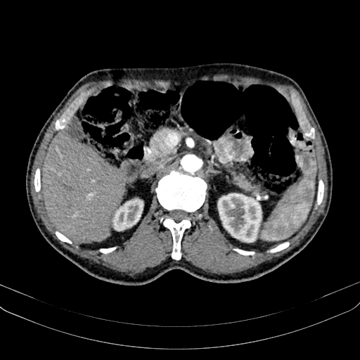 Abdominal aortic aneurysm (Radiopaedia 83581-98689 Axial C+ arterial phase 43).jpg