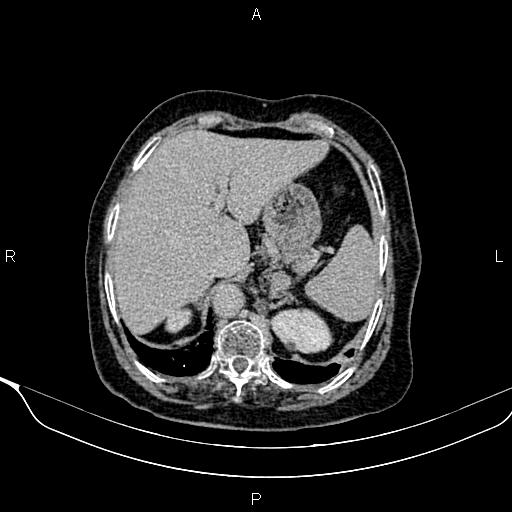 Abdominal aortic aneurysm (Radiopaedia 85063-100606 Axial C+ delayed 8).jpg