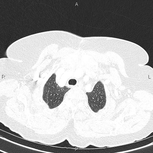 Abdominal aortic aneurysm (Radiopaedia 85063-100606 Axial lung window 15).jpg