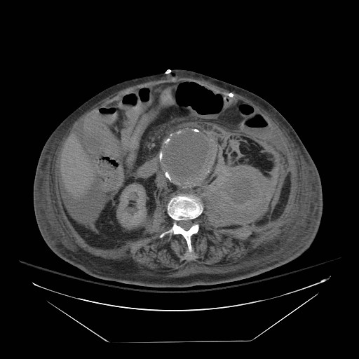 Abdominal aortic aneurysm - impending rupture (Radiopaedia 19233-19247 Axial non-contrast 89).jpg