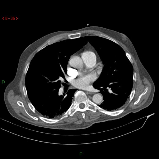 Abdominal aortic aneurysm rupture with aortocaval fistula (Radiopaedia 14897-14841 Axial C+ arterial phase 35).jpg