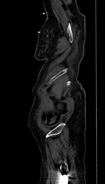 Abdominal aortic aneurysm with thrombus fissuration (Radiopaedia 73192-83919 Sagittal C+ arterial phase 135).jpg