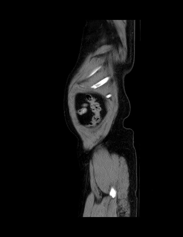 Abdominal lymphoma - with sandwich sign (Radiopaedia 53486-59492 Sagittal C+ portal venous phase 1).jpg