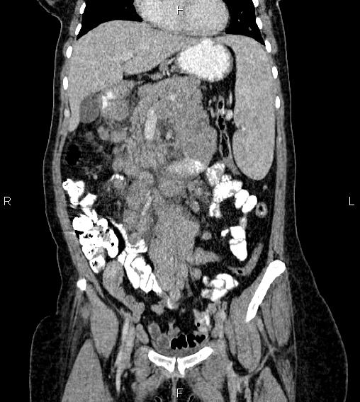 Abdominal lymphoma with sandwich sign (Radiopaedia 84378-99704 Coronal C+ portal venous phase 20).jpg