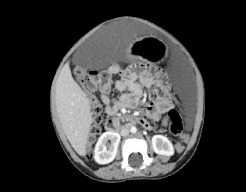 Abdominal premesenteric cystic lymphangioma (Radiopaedia 82995-97350 Axial C+ portal venous phase 29).jpg