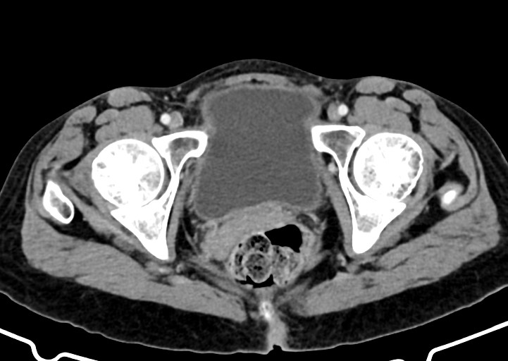 Abdominal wall and retroperitoneal tuberculosis (Radiopaedia 88137-104729 Axial C+ portal venous phase 183).jpg