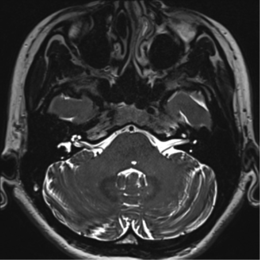 Abducens nerve palsy (Radiopaedia 51069-56648 Axial T2 fat sat 21).png