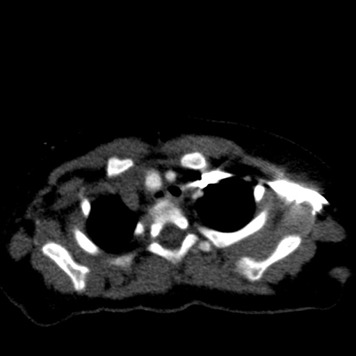 Aberrant left pulmonary artery (pulmonary sling) (Radiopaedia 42323-45435 Axial C+ CTPA 10).jpg