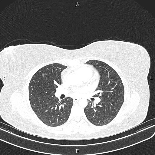 File:Aberrant right subclavian artery (Radiopaedia 87334-103629 Axial lung window 34).jpg