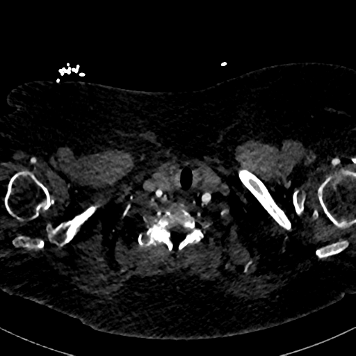Aberrant right subclavian artery with Kommerell diverticulum (Radiopaedia 47982-52769 Axial C+ arterial phase 2).png