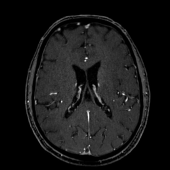 Accessory middle cerebral artery (Radiopaedia 73114-83828 Axial MRA 127).jpg