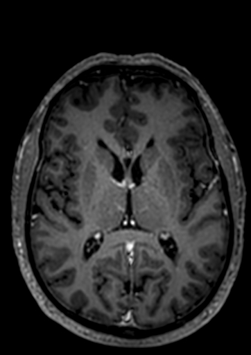 Accessory middle cerebral artery (Radiopaedia 73114-83828 Axial T1 C+ 21).jpg