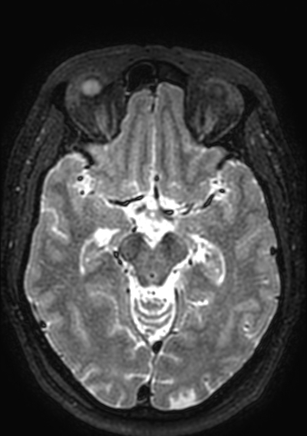 Accessory middle cerebral artery (Radiopaedia 73114-83828 Axial T2 107).jpg