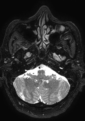 Accessory middle cerebral artery (Radiopaedia 73114-83828 Axial T2 179).jpg