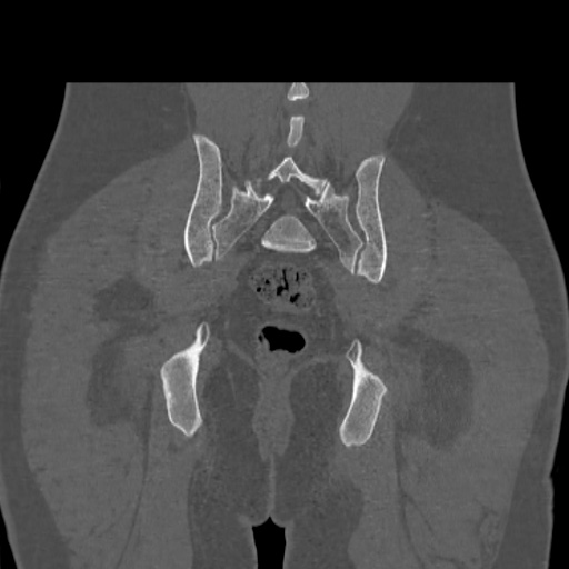 Acetabular and ilial fractures (Radiopaedia 59084-66378 Coronal bone window 43).jpg