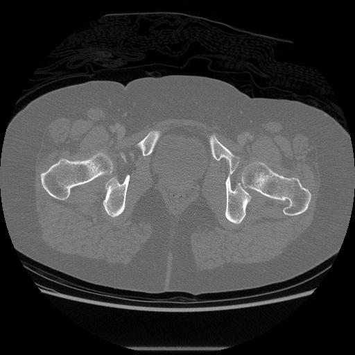 File:Acetabular fracture (Radiopaedia 13193-13212 Axial bone window 43).jpg